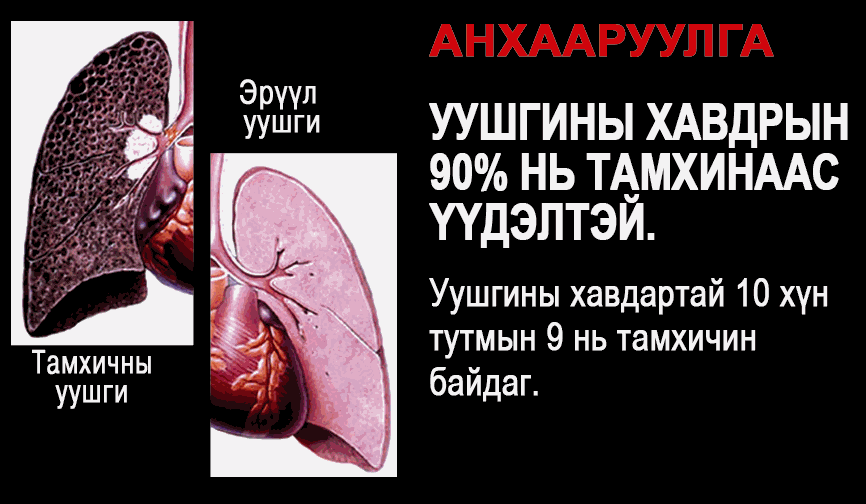 Mongolia 2010 Health Effects lung - diseased organ, lung cancer, gross